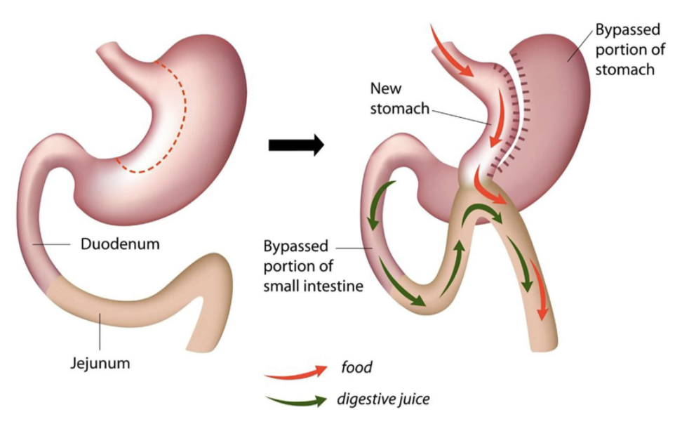 Mini Gastric Bypass Weight Loss Surgery Blackrock WeightCare