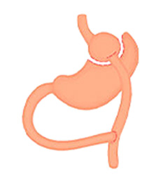 Roux-en-Y Gastric Bypass icon