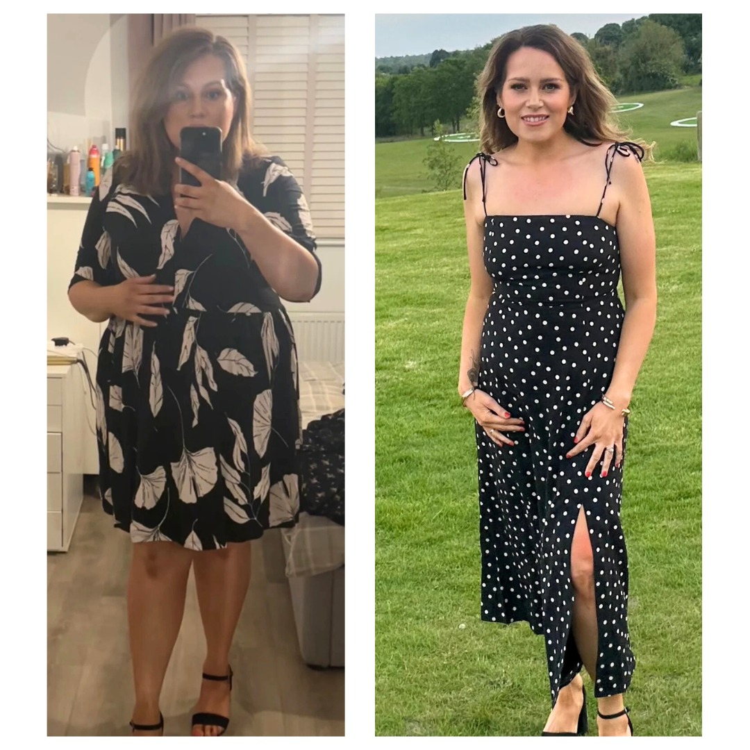 Gastric Sleeve Surgery Results at Blackrock WeightCare