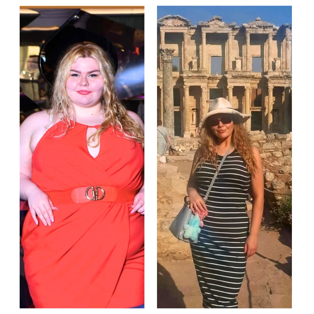 Mini Gastric Bypass Success story at Blackrock WeightCare, Dublin