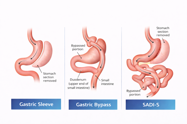 Gastric Sleeve Vs Gastric Bypass Vs SADI