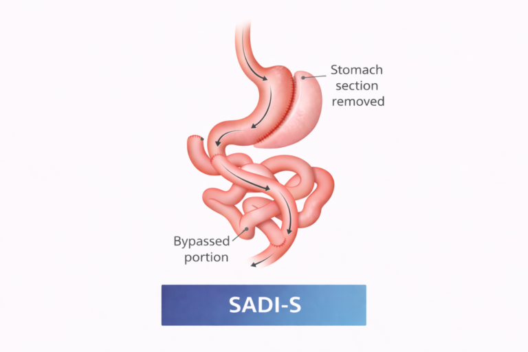 SADI-S Surgery