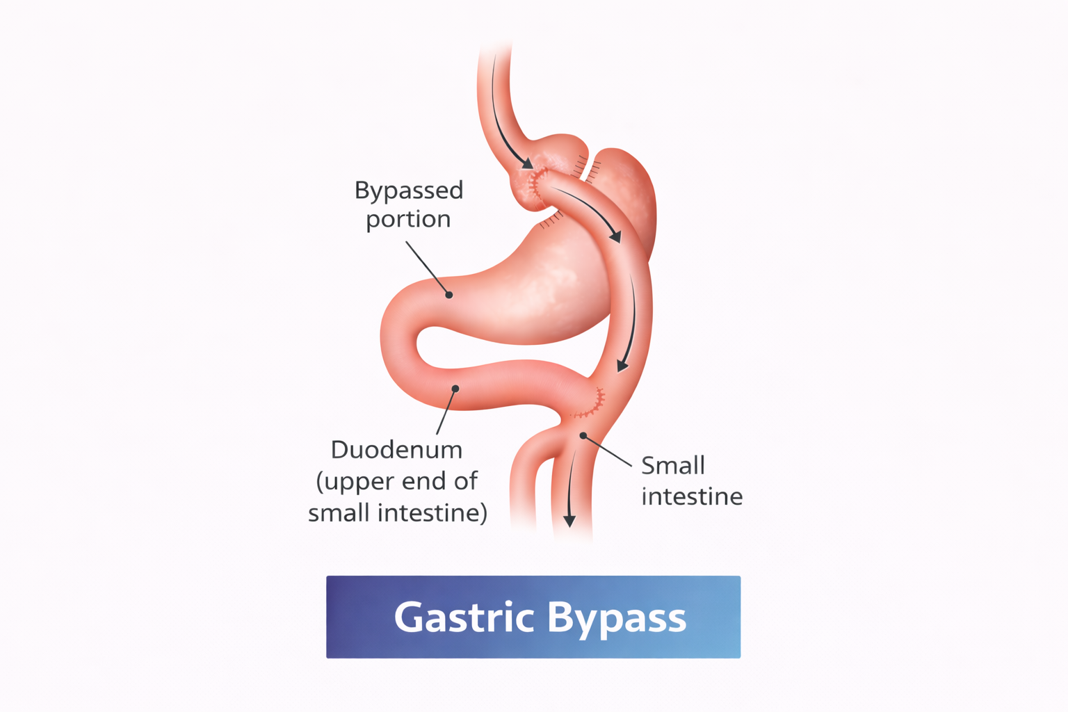 Gastric Bypass