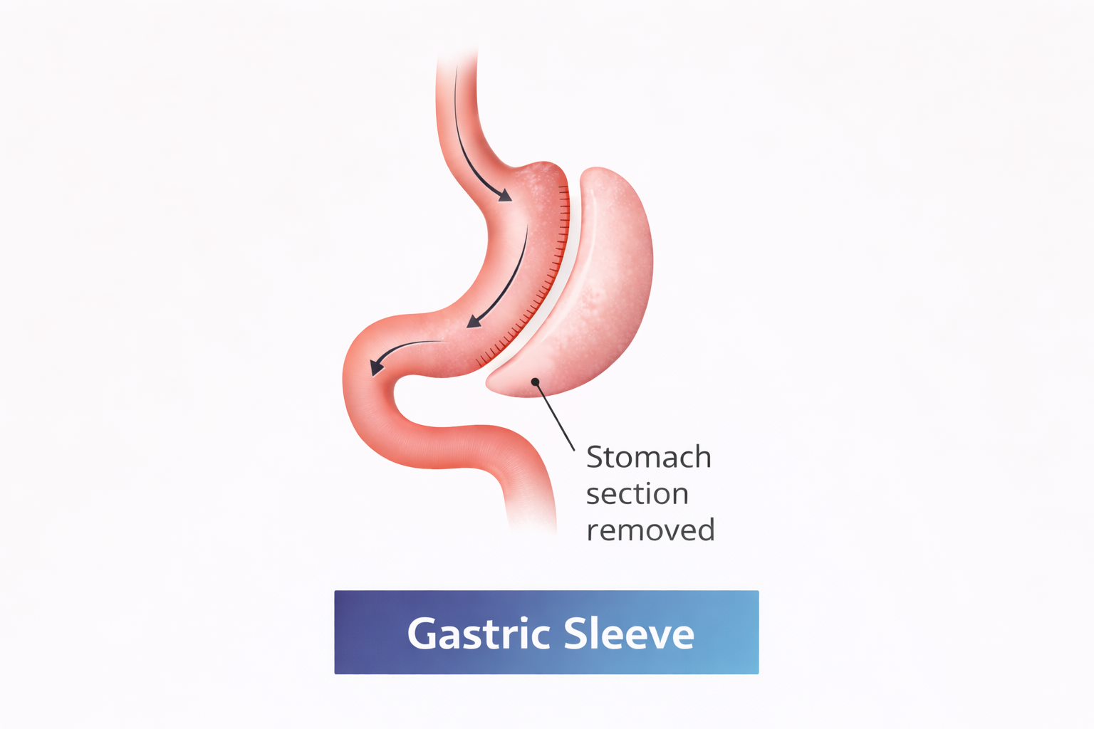 Gastric Sleeve
