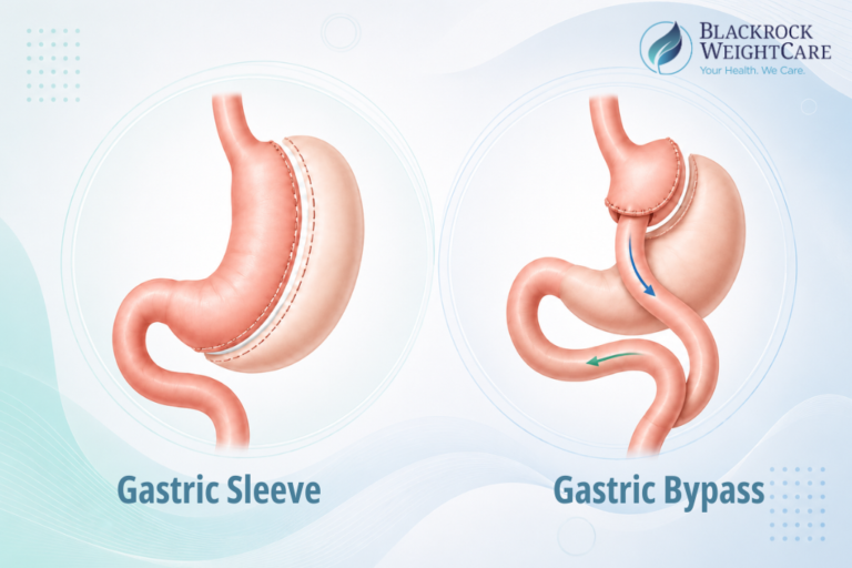 Gastric Sleeve Vs Gastric Bypass